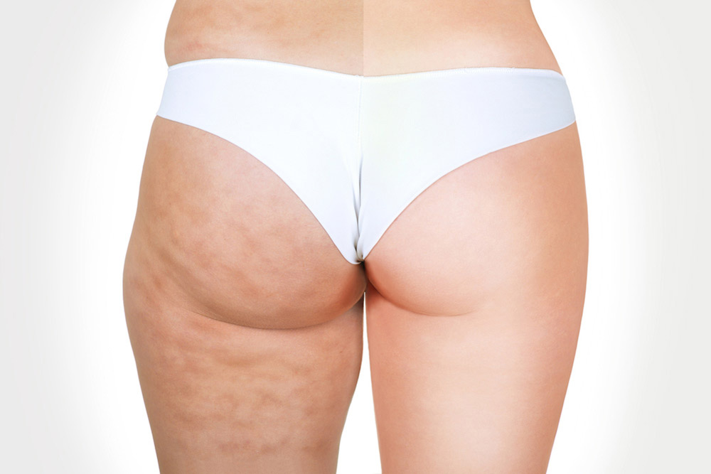 Gesäß und Oberschenkel 
mit und ohne Cellulite